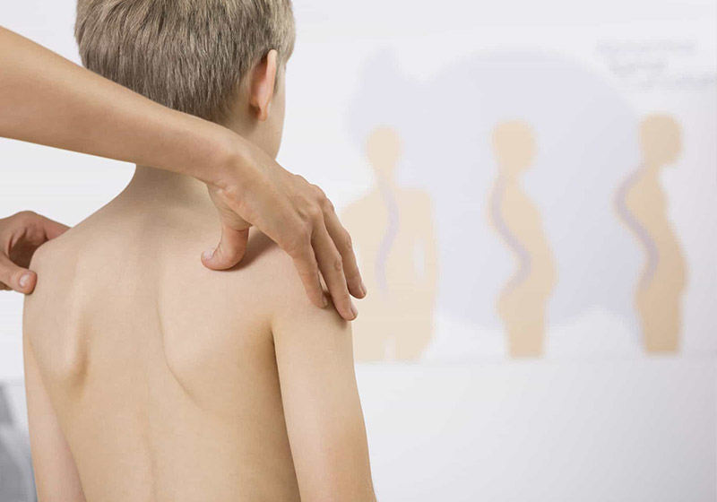 Ragazzo con scoliosi idiomatica giovanile durante una sessione di fisioterapia